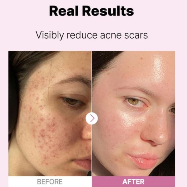 The Niacinamide 15% Serum